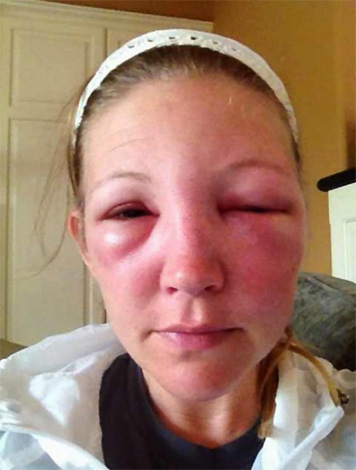 After the bite of the Japanese hornet, a powerful allergic reaction can develop, accompanied by severe tissue swelling.