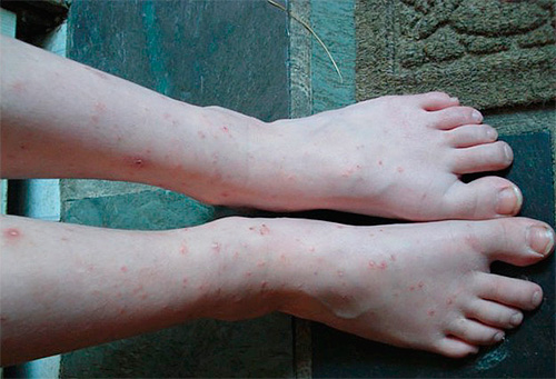The photo shows feet, bitten by domestic fleas.