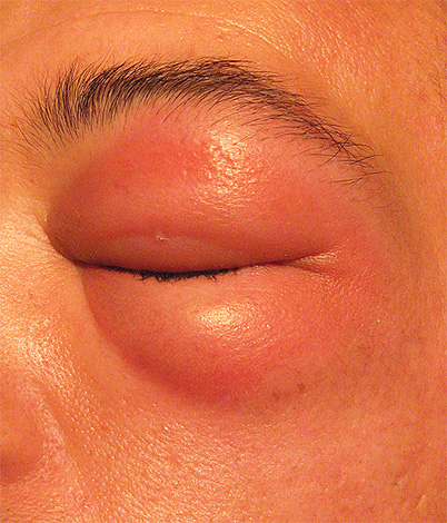 The photo shows the effects of a hornet bite in the eyelid.