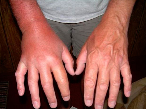 The photo shows the swelling of the arm after wasp bite.