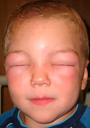 With wasp stings, in addition to severe edema, body temperature can also rise and general well-being deteriorate.