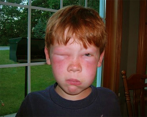 If the bite of a wasp fell on the face or neck of a child, the reaction may be more pronounced than in the case of hitting the hands or feet.