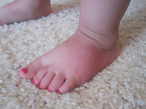 The effects of wasp stings in children are usually limited to a local reaction in the form of slight swelling and pain.