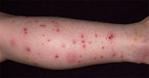 Flea bites are not only painful, but also often lead to the formation of pustules on the skin.