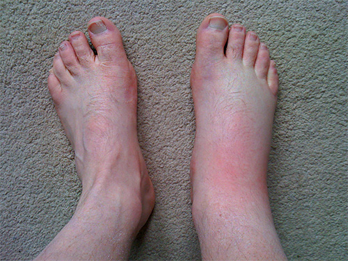 If a stinging insect has bitten, for example, in the foot, swelling can spread to the entire leg.