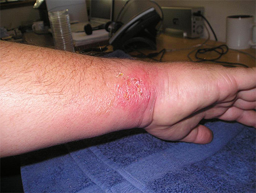 If you are constantly combing the site of a wasp sting, then there is a greater likelihood of infection in the wound.