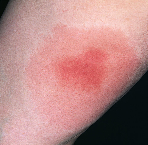 Inflammation caused by wasp sting