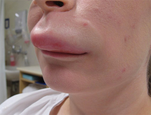 Swelling of the lips of the wasp after the bite of a wasp