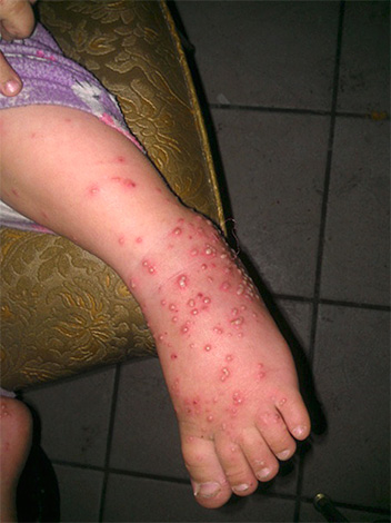 Pustules on the leg of a child