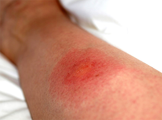 Sensitivity to insect bites may vary significantly from person to person.