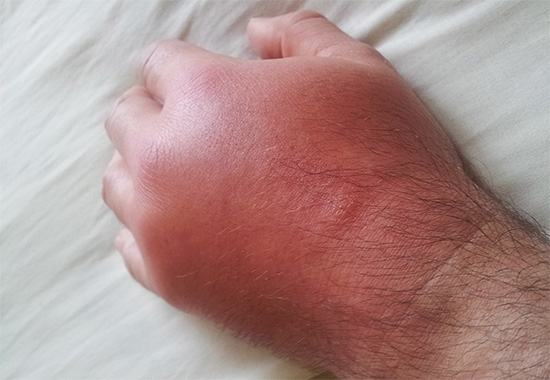 Often, a wasp sting in the affected area causes not only inflammation and swelling, but also severe itching.