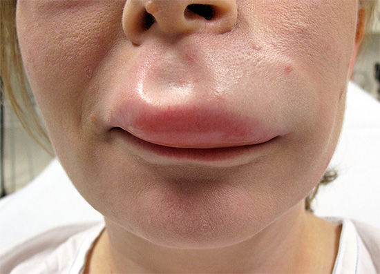 Even a wasp sting in the lip looks pretty scary, but imagine what happens if several insects bite a human throat ...