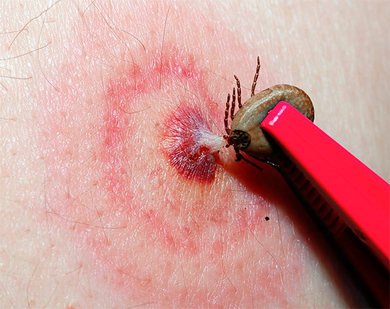 Ticks do not bite at all, but they are very dangerous because of their ability to be carriers of serious human diseases.