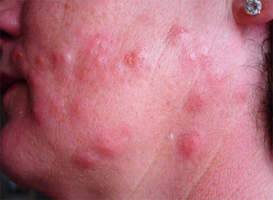 Bites bed bugs, especially with a large number of them, it is simply impossible not to notice.