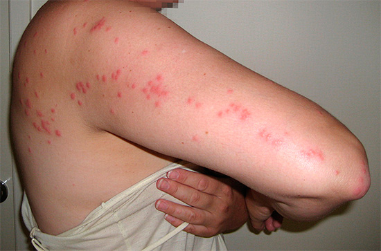 This is the characteristic path from the bites of bed bugs on the body of their victim.
