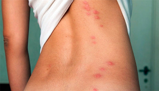 If traces of insect bites are arranged in chains, then there is every reason to suspect that it was the bed bugs that left them.