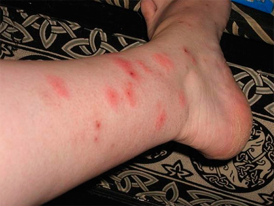 The favorite place of a flea attack is the legs and arms of a person, especially if they are not completely covered by clothes.