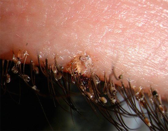 This photo clearly shows the pubic louse and nits on the eyelashes of a person.