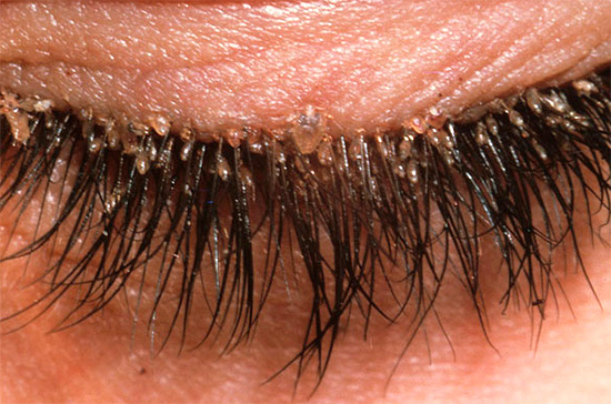 Another example of lice infested eyelashes.