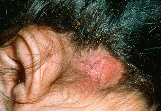 With a large number of lice on the scalp can appear scabs.