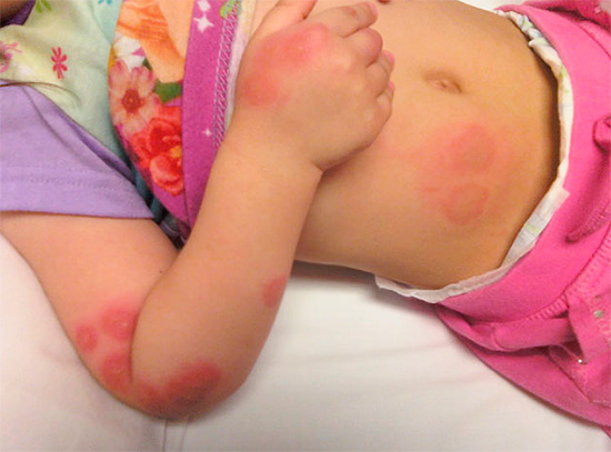 This photo shows traces of bedbug bites on a child.