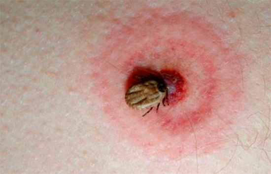 As a rule, the tick bite is surrounded by a kind of red rims.