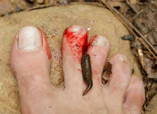 The leech stuck to the man’s toe.