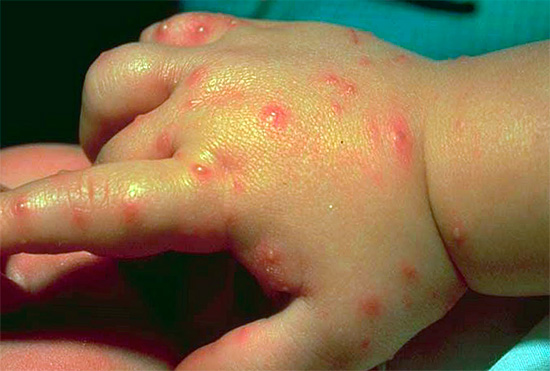 Barnets hand, biten av bedbugs