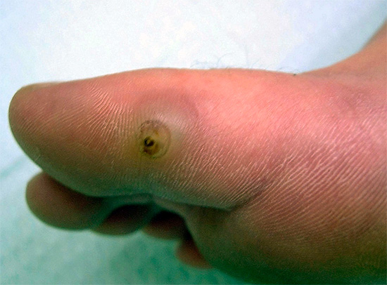 Sandiga loppor kan tränga igenom huden, vilket leder till allvarlig och farlig inflammation.