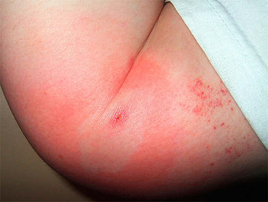 Ofta i mitten av biter av olika insekter kan man se spåret av en punktering av huden.
