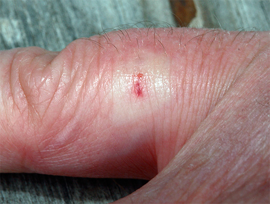 Όταν επιτίθεται σε μια σφήκα στην πληγείσα περιοχή, παρατηρείται μια μικρή διόγκωση και παρατηρείται συχνά υποδόρια αιμορραγία.