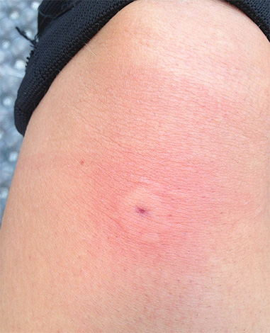 The photo shows how the wasp bite looks immediately after stinging.