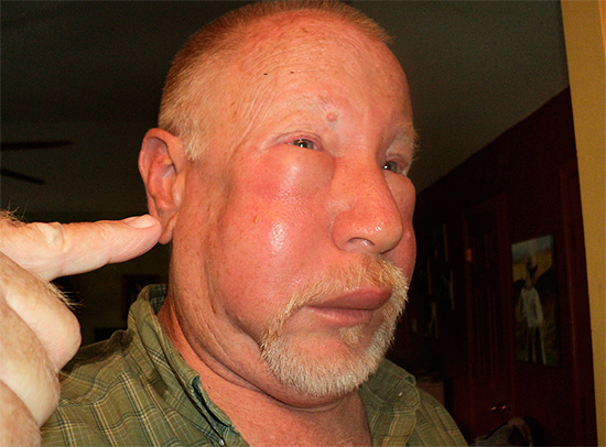 Tumor on the face after hornet bite