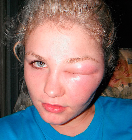 When the bites of bees, wasps and hornets in the eyelid or in the immediate vicinity of the eye, it often closes completely due to the strong swelling of the tissues affected by the poison.