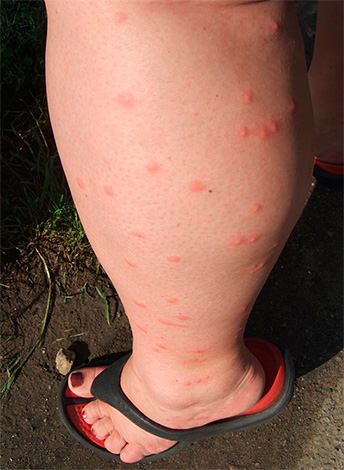 Kis piros pontok a lábon - számos bolha harapás.