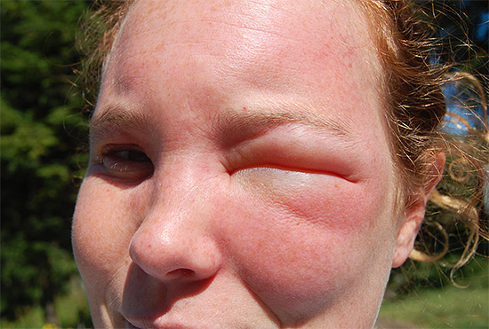 A darázscsípés az arcán gyakran nagyon erős ödémához vezet, és mindkét szem egyszerre záródhat.