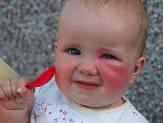 Kisgyermekeknél a látszólag ártalmatlan rovarok harapásai kezelés nélkül néha veszélyes formát ölthetnek.