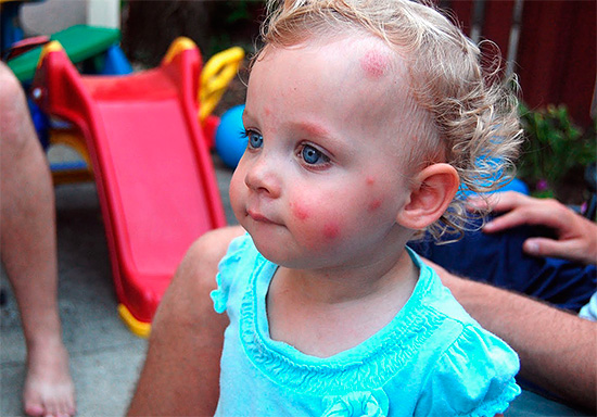 A kisgyermekek néha nagyon érzékenyek a hétköznapi szúnyogcsípésekre is.
