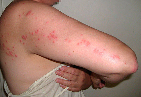 Gyakran előfordulhat, hogy a buggyulladásokat az áldozat bőrén lévő vörös pontok jellegzetes láncai felismerik.