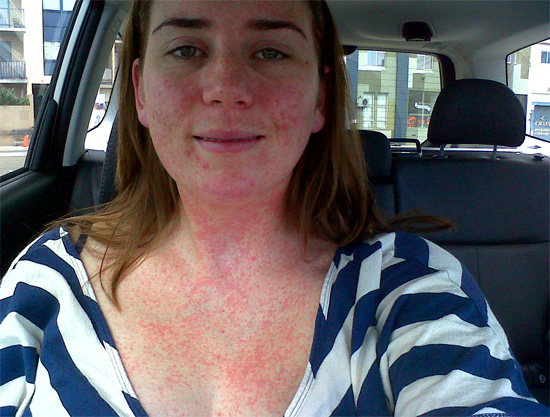 Insektsbekämpning av hud och luftvägar kan ibland leda till en allvarlig allergisk reaktion.