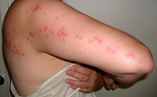 Bedbug bites utgör ofta en karakteristisk väg på offrets hud.