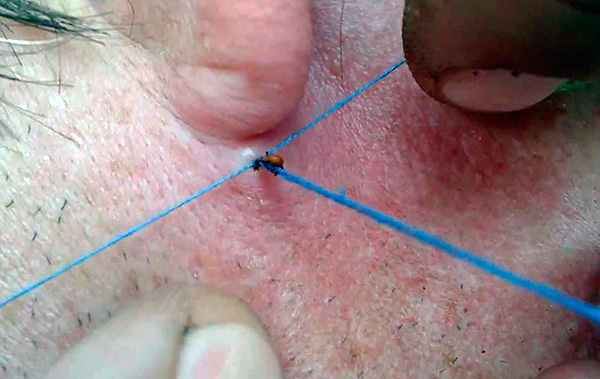 The photo shows an example of extracting a tick from a wound using a thread.