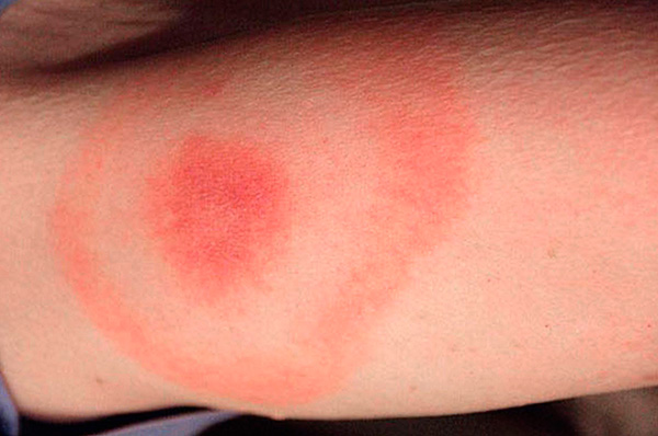 Concentric red circles around the tick bite site indicate Lime Borreliosis infection.