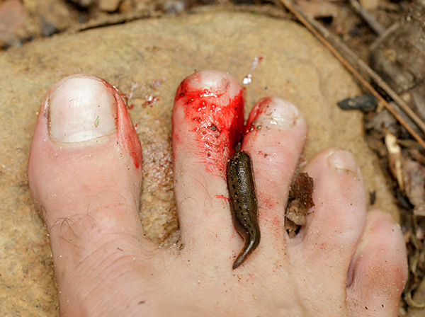 Leech bites are usually accompanied by prolonged heavy bleeding.