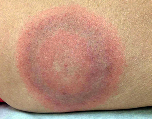Taková skvrna (erytém prstence) je prvním příznakem infekce lymské boreliózy.