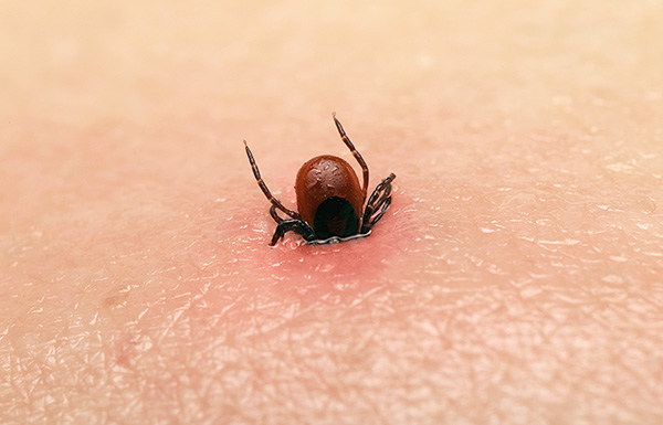 The nuances of first aid for a tick bite ...