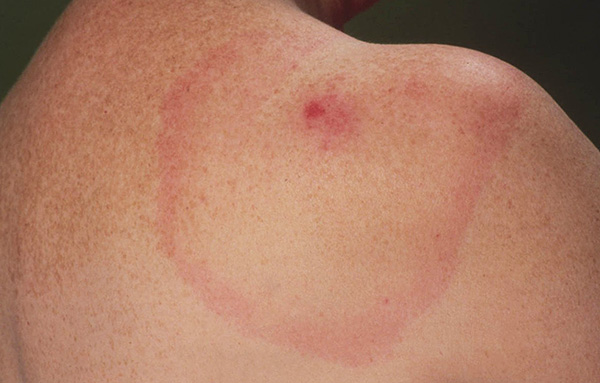 Even if there are no obvious symptoms of the disease, the condition of the victim should be carefully observed for at least 2 months after the tick bite.