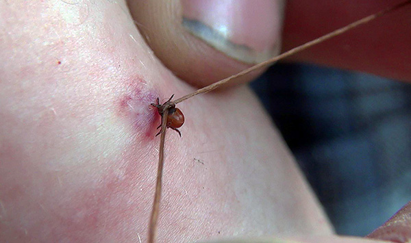 The photo shows an example of removing a sucked tick with a thread.
