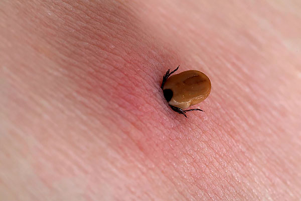Finding out how you can safely get a sucked tick from a person's skin ...