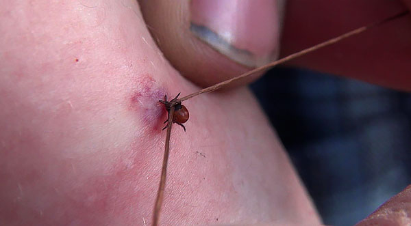 An example of extracting a parasite sucked with a thread.